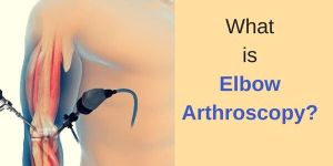 Elbow Arthoscopy Treatment