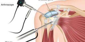 Shoulder Arthroscopy