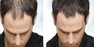 Hair Problem Treatment