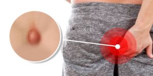 Pilonidal Sinus Treatment