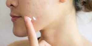 Tea Tree Anti Acne Cream