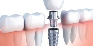 Dental Implants