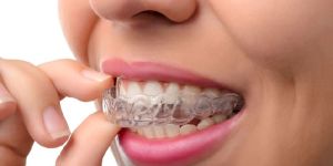 Invisalign Treatment