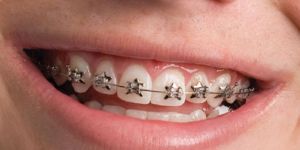 Orthodontic Treatment