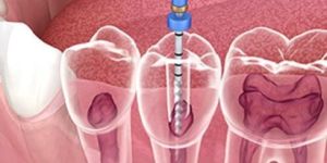 Root Canal Treatment