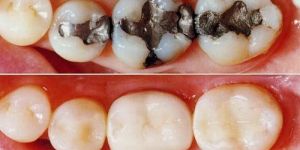 Teeth Fillings