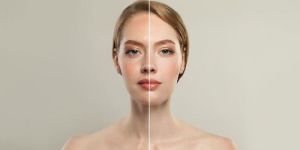 Laser Skin Tightening