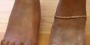 Silicone Foot Prosthesis