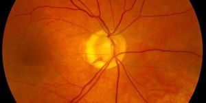 Retinopathy Stem Cell Treatment Services