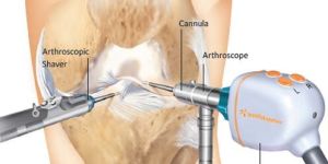 Knee Arthoscopy Treatment