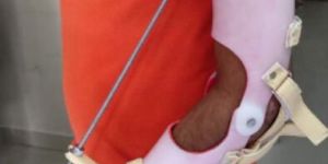 Elbow Turnbuckle Splint