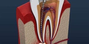 Painless Root Canal Treatment