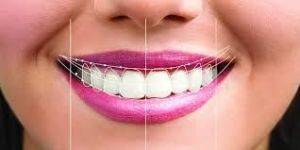 Smile Designing