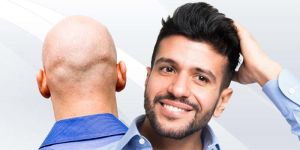 Hair Transplantation