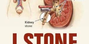 I-Stone Ayurvedic Capsules