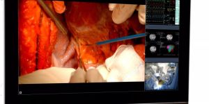 MDMX25500 GNNB Surgical Displays