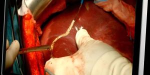 MDSC8532 SSTF / NXF surgical display