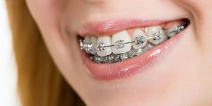 Braces / Orthodontics Treatment