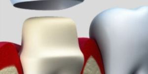 Crowns Artificial Teeth Cover