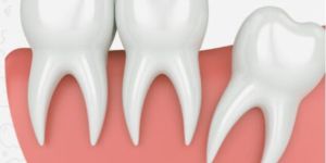 Extraction/Tooth Removal