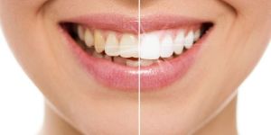 teeth-whitening service