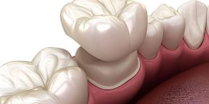 Dental Crowns