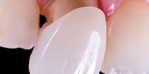 Dental Veneers