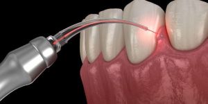 Laser Gum Treatment