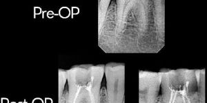 Microscopic Root Canal Treatment