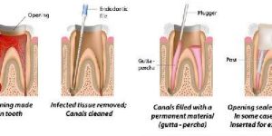 Root Canal Treatment Service