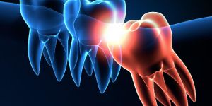 Wisdom Tooth Extractions