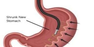 Endoscopic Sleeve Gastroplasty
