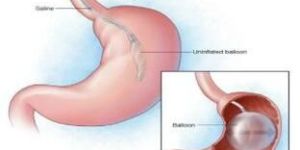 Intragastric Balloon Insertion