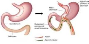 Mini Gastric Bypass Surgery