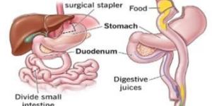 Roux-en-y-Gastric Bypass