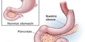 Sleeve Gastrectomy