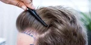 Fue Hair Transplant Service