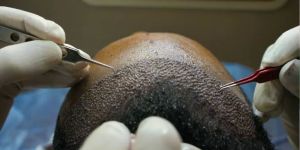 Hair Grafting Surgery