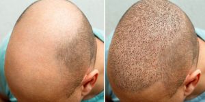 Hair Transplant Service