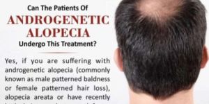 Male Hair Loss Treatment Service