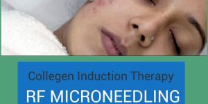 Pimple Scar Treatment