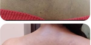 Skin Polishing - Microdermabrasion