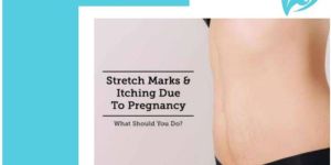Stretch Marks Removal Service