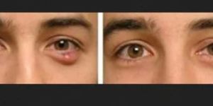 Eye Treatment Service