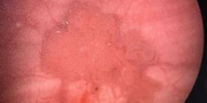 Bladder Cancer Surgeon