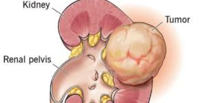 Kidney Cancer Treatment Services