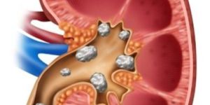 Kidney Stone Removal