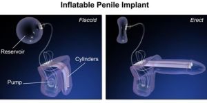 Penile Implants Treatment Services