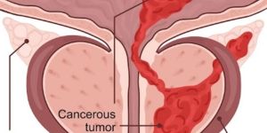 Prostate Cancer Treatment Services