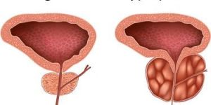 Prostate Enlargement Treatment Service